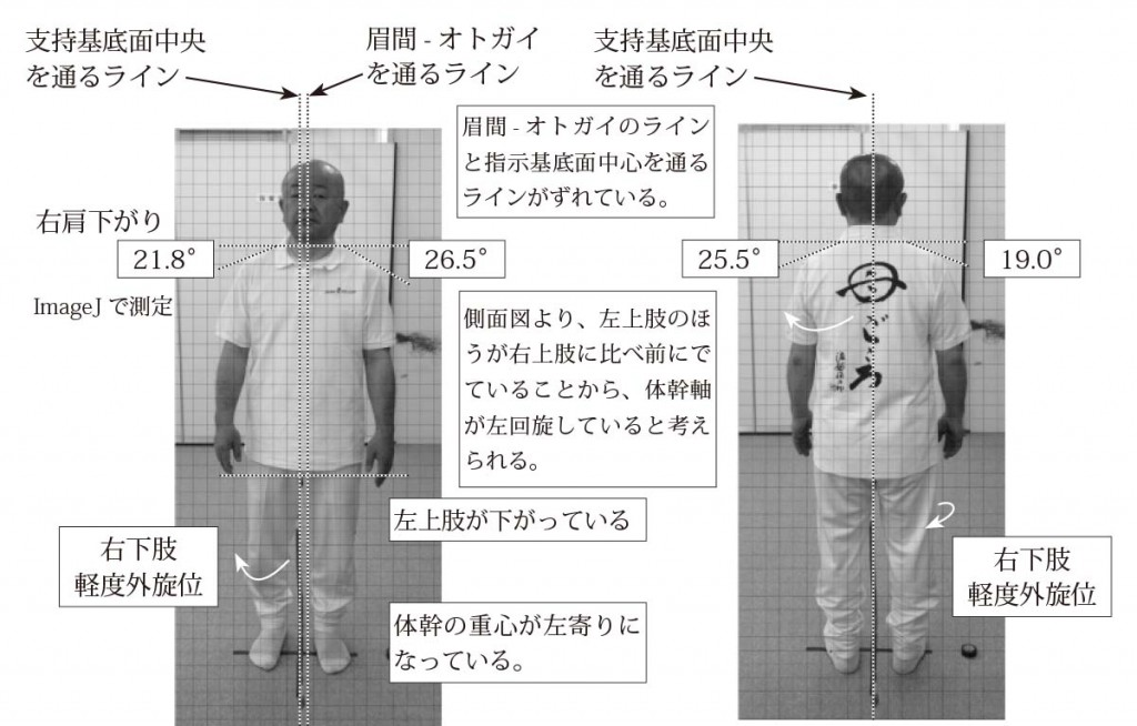 フリーウェアを用いた姿勢分析並びに関節可動域測定：黒澤一弘 | 日本