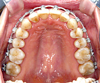 バンドについて - 杉山矯正歯科