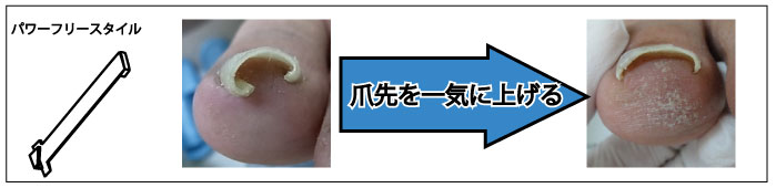 痛くない巻き爪補正&フットケアのペディグラス