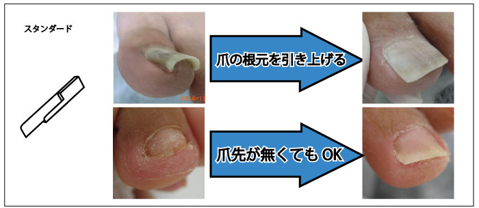 痛くない巻き爪補正&フットケアのペディグラス