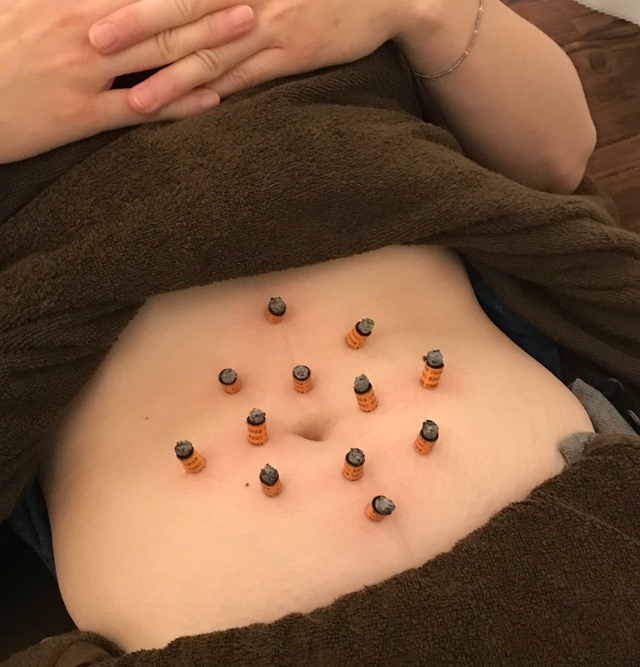 真治堂鍼灸接骨院、温灸治療のページです。 - 真治堂鍼灸接骨院（西