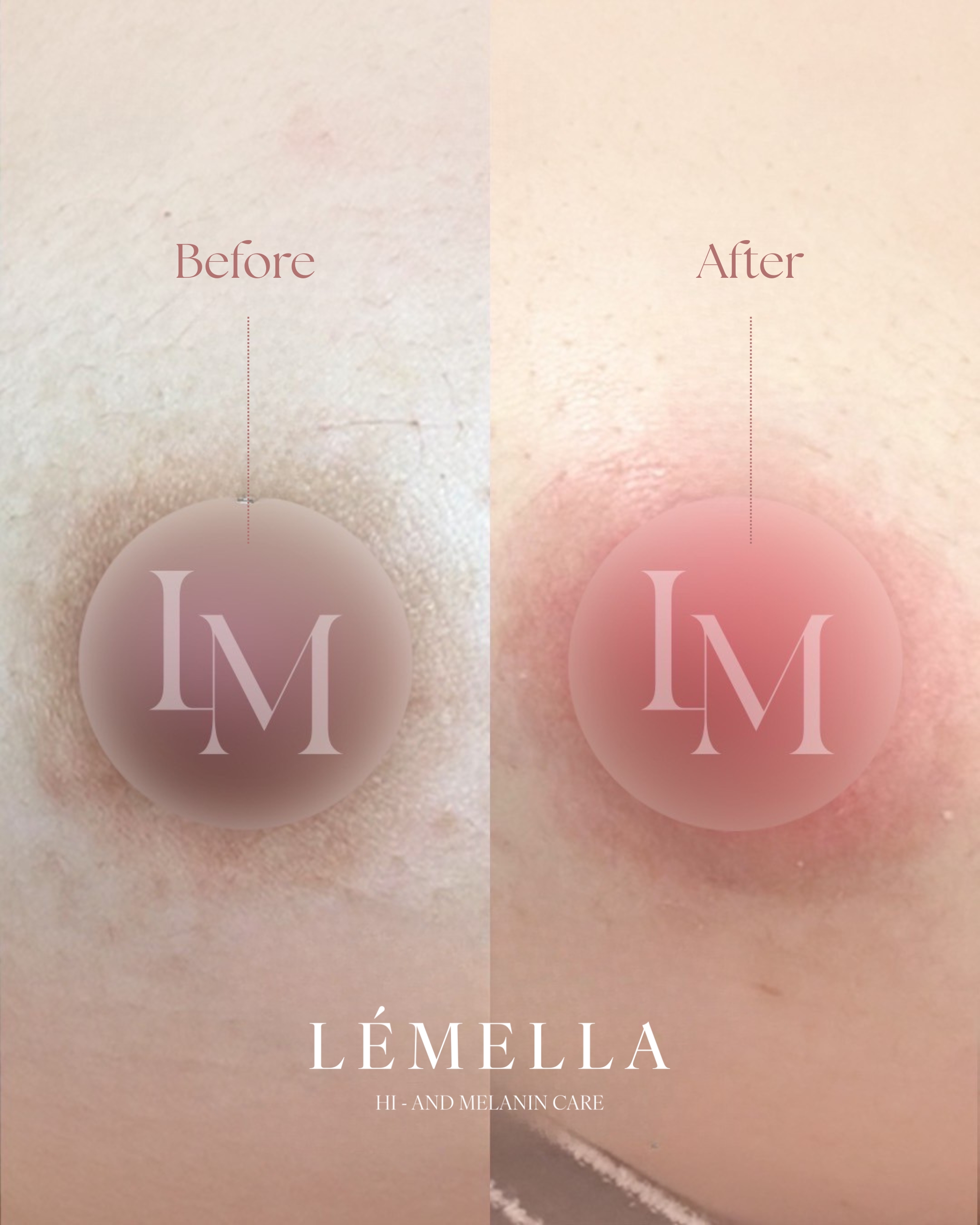 ルメラ（LEMELLA）メラニンケア｜豊橋の美容皮膚科 遠山クリニック