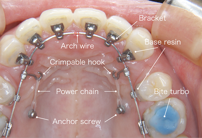 歯の裏側からの矯正 | 横浜の矯正歯科はSYNC横浜元町矯正歯科