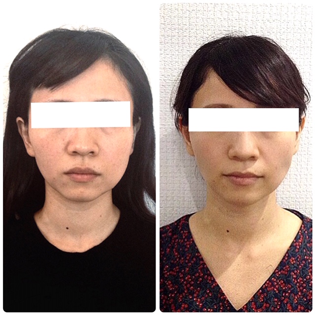 フェイスラインの左右差が変わった」30代 女性