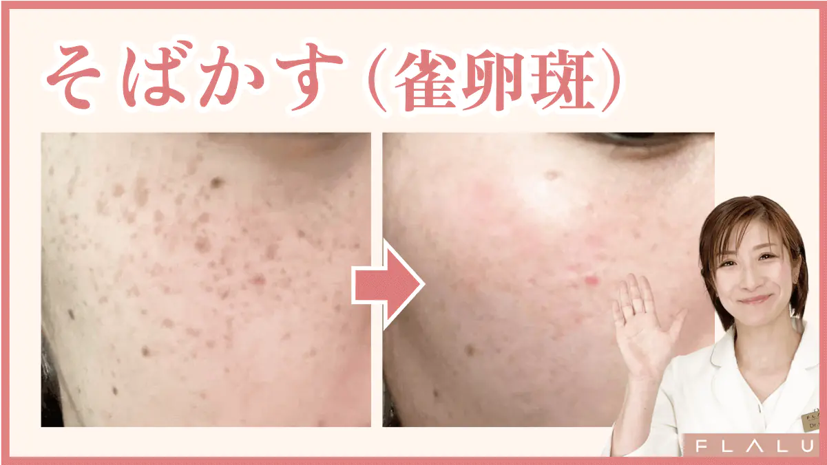 そばかすレーザー - 秋田市の美容皮膚科 AdeBクリニック