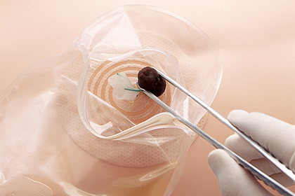 サージドレーン・ジッパー｜商品情報｜アルケア株式会社（医療関係者向け）