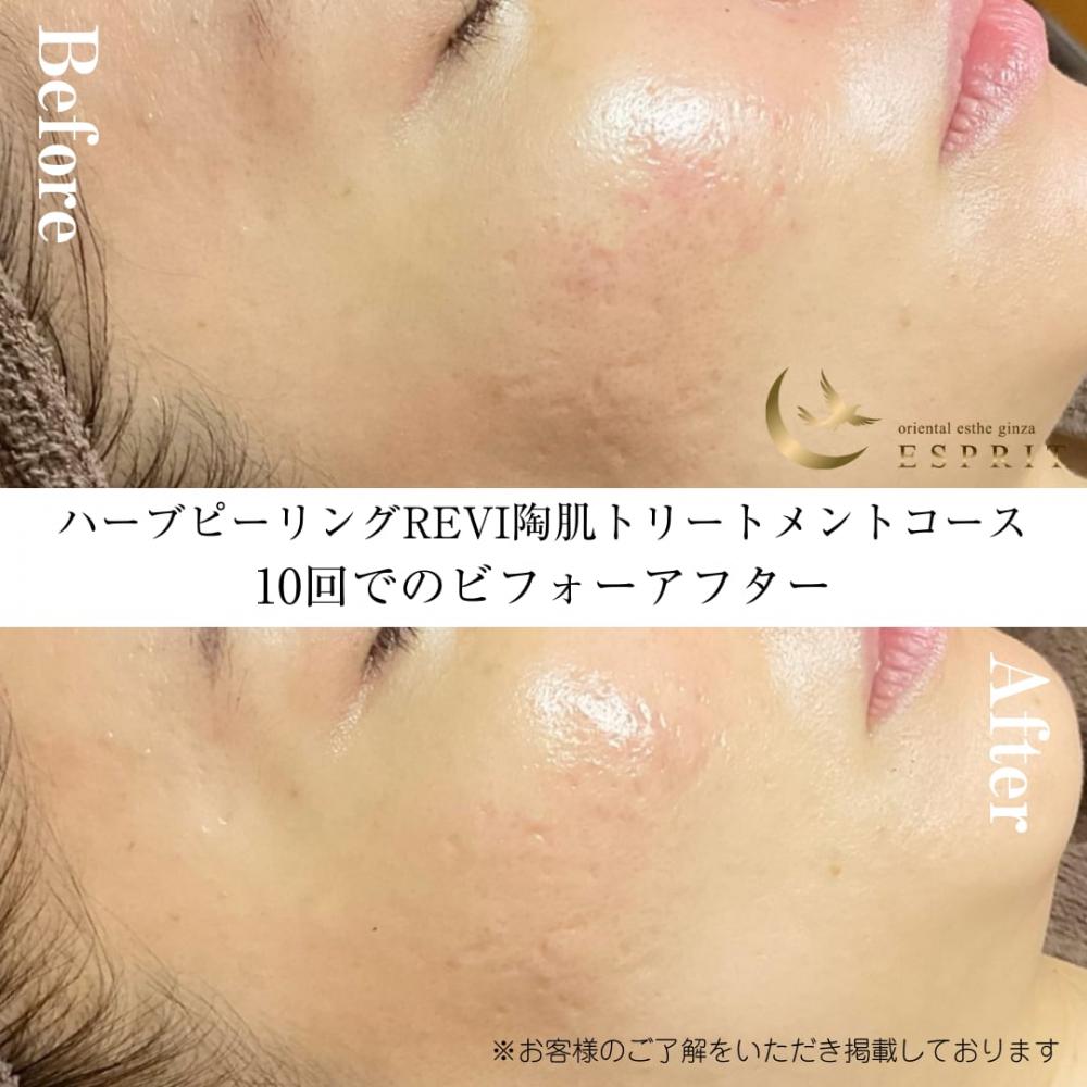 ハーブピーリングREVI【ルヴィ】陶肌トリートメント ｜東京銀座、新宿