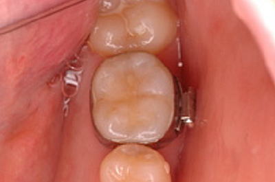 ドキュメンタリー矯正治療 / ステップ4 【公式】立川市 OPひるま歯科