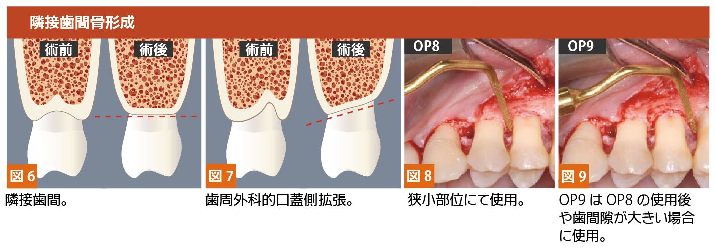 インサートチップOP8｜株式会社インプラテックスの取扱い商品