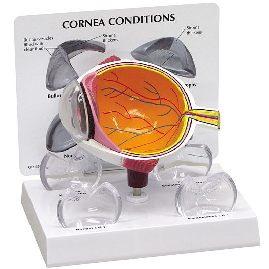 医学模型 眼球断面と角膜疾患