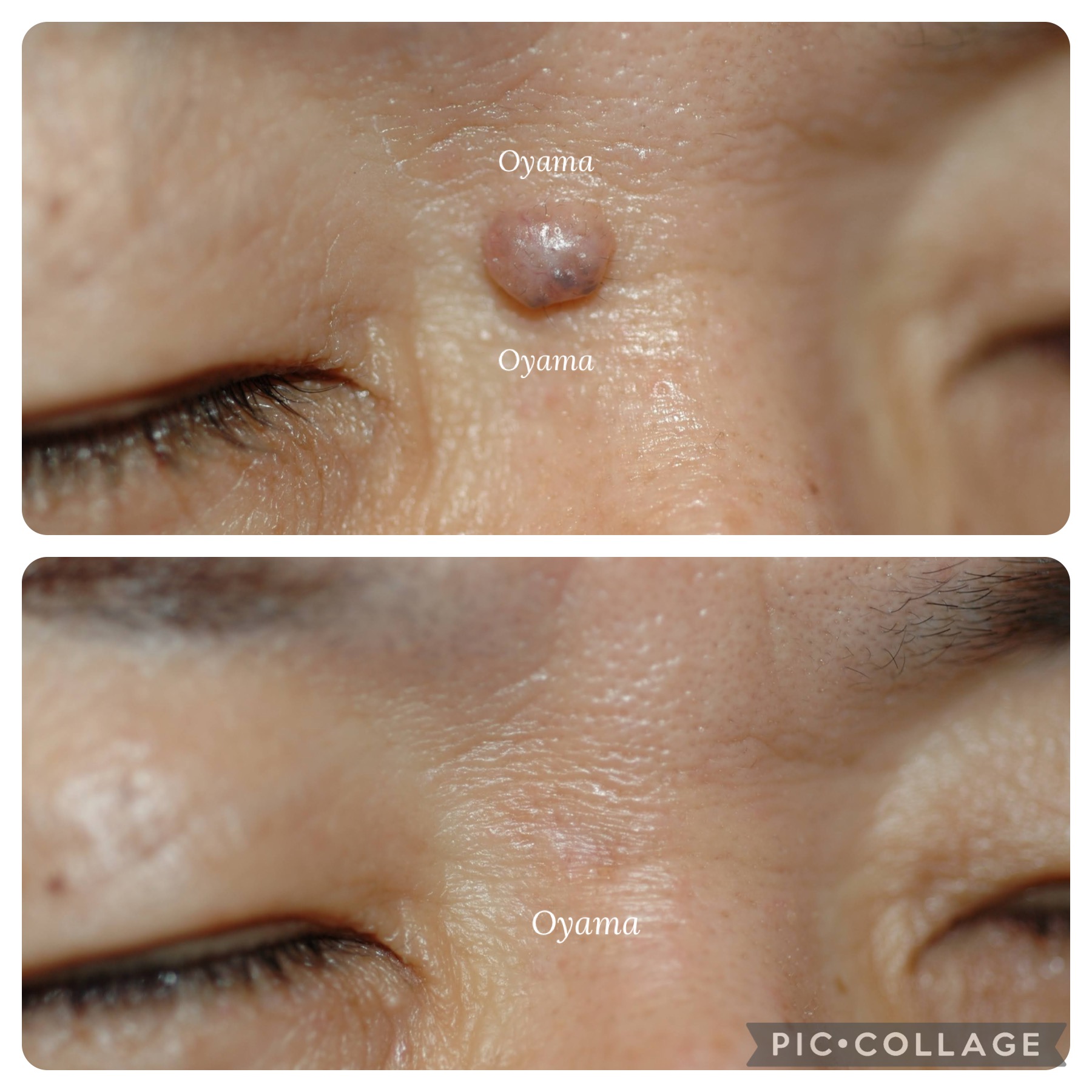 目の周りのほくろ除去(目の上・目の下)｜大山皮膚科｜足立区 五反野駅1