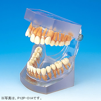 透明レジン製不正咬合模型 [P12P-O各種](P咬合器つき)｜株式会社