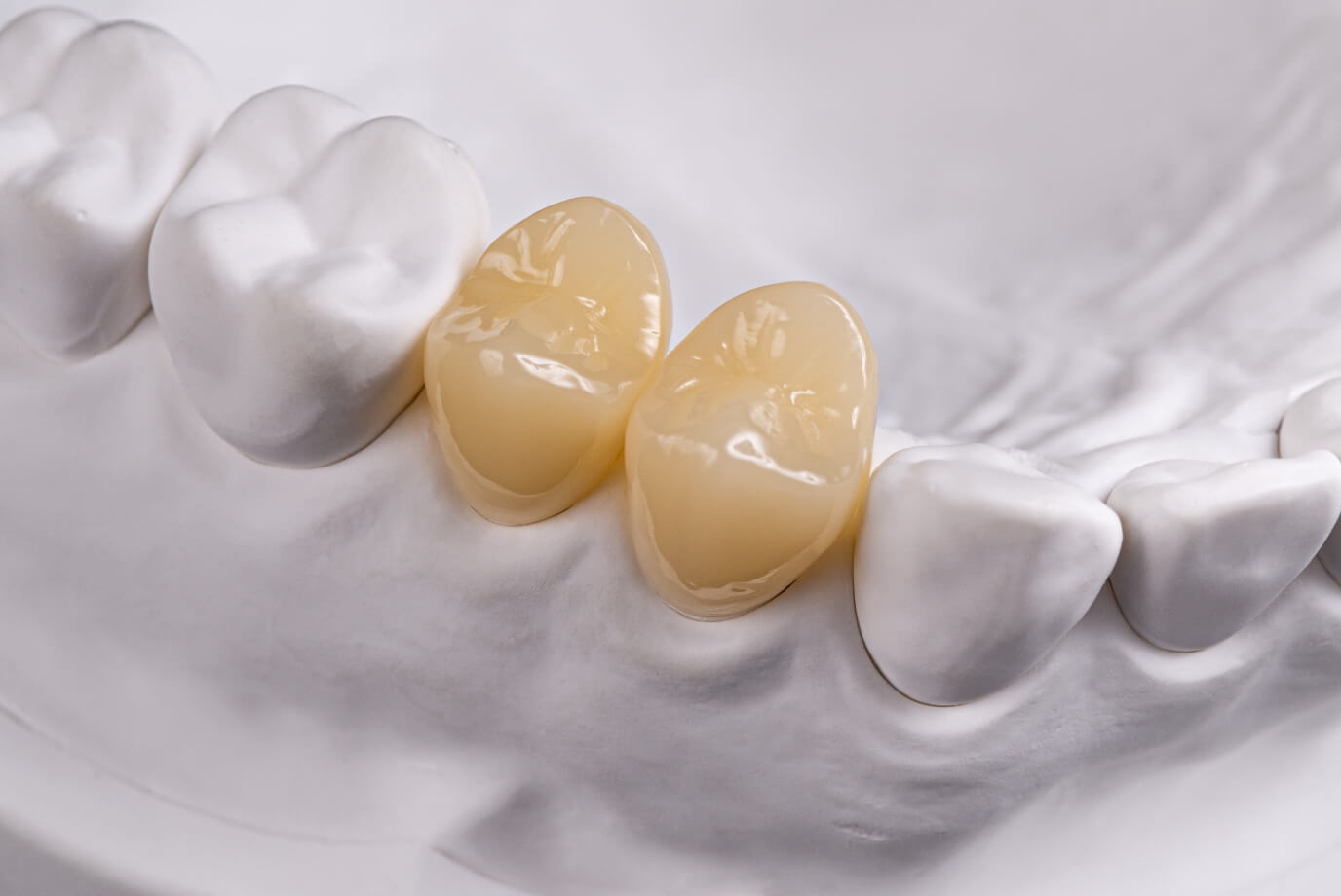 歯冠修復補綴物［CAD／CAM冠］｜株式会社シケン