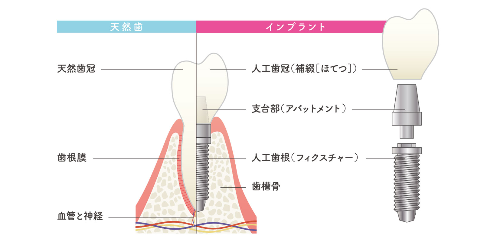 武蔵境でインプラント治療なら武蔵境すきっぷ通り歯科