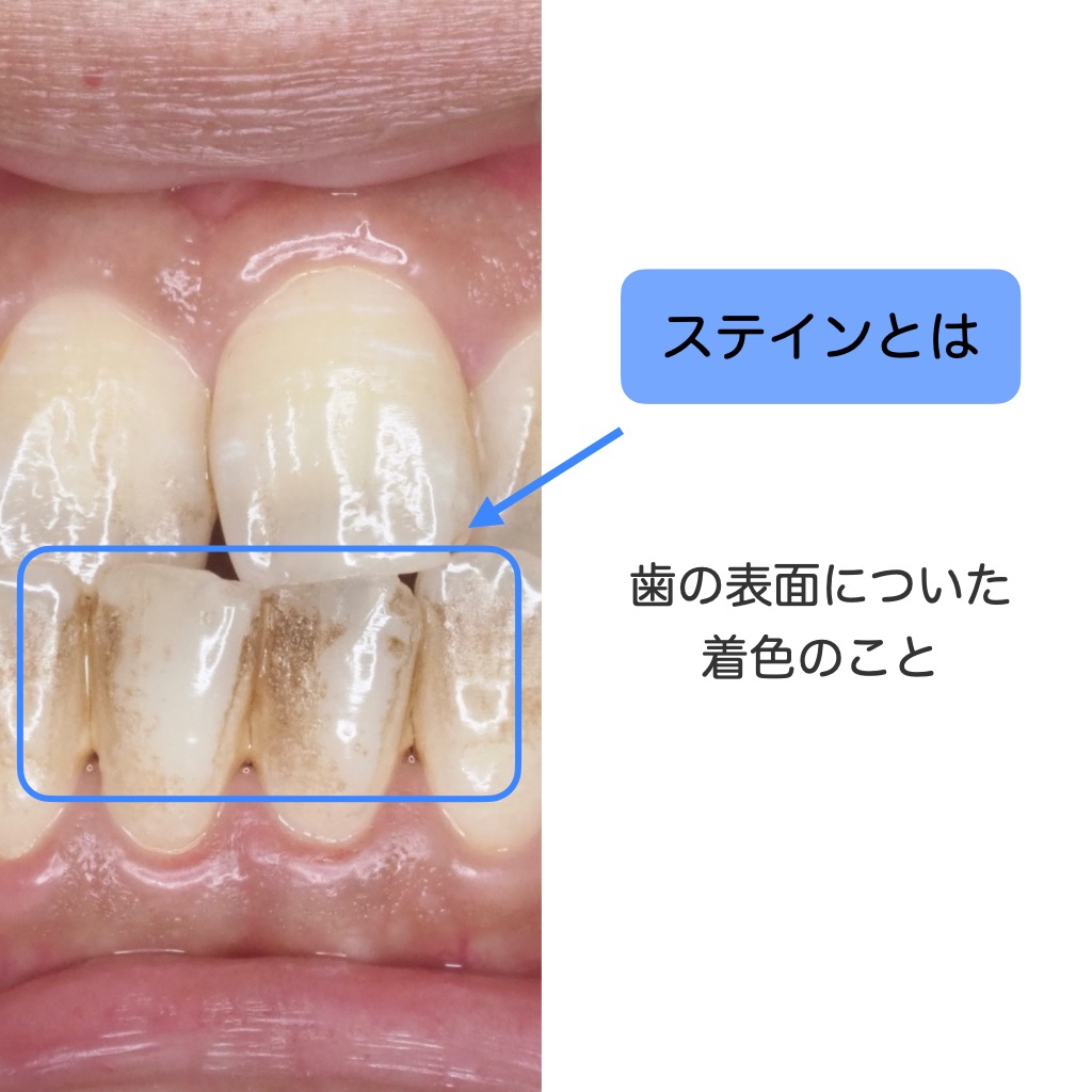 ホワイトニング – 豊中市・蛍池の歯医者・歯科医院で前歯の矯正・精密