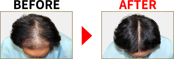 薄毛改善・発毛専門リーブ21 リーブ21の発毛システムを濃縮して体験