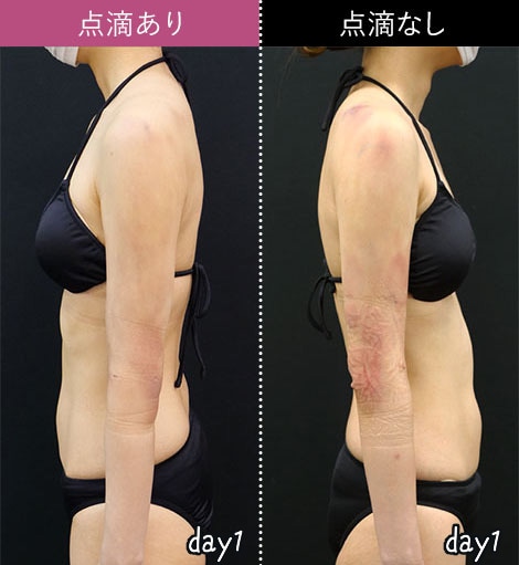 ダウンタイムの少ない脂肪吸引｜脂肪吸引なら湘南美容クリニック【公式】