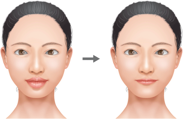 唇を薄く（たらこ唇） ： 口もと（口元）・くちびる（唇）：美容外科