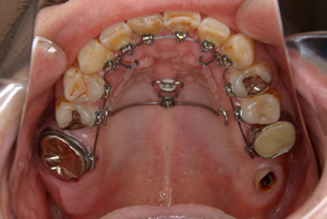 歯科矯正用アンカースクリューを用いた矯正(歯科)治療｜帯広市の矯正