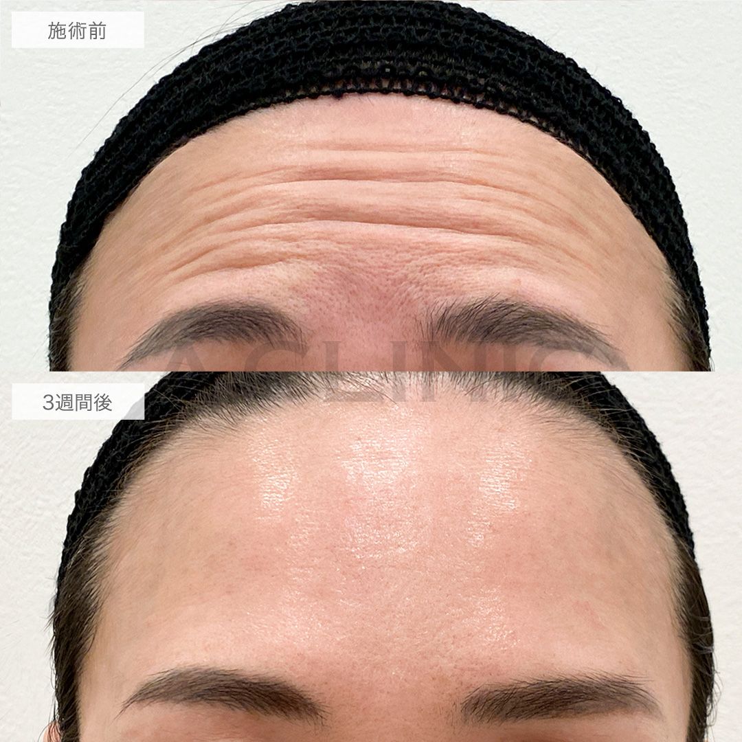 額と眉間のボトックス注射でツルツルおでこに！こちら処置前と3週間後