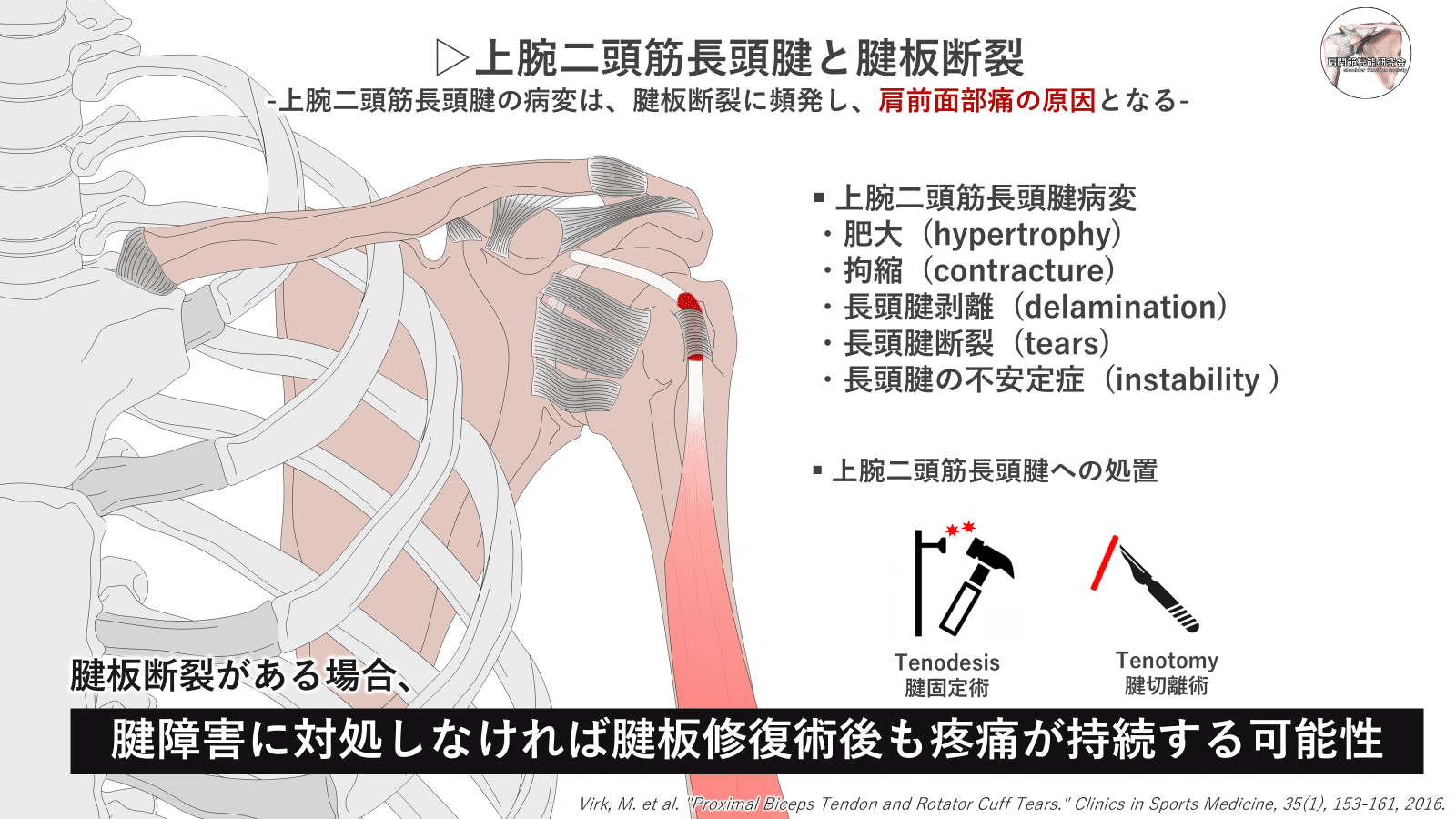 エビデンスに基づく上腕二頭筋長頭腱炎｜肩関節機能研究会 郷間