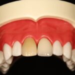 患者様説明用模型 – 【公式】広島市の歯科技工所「株式会社アート