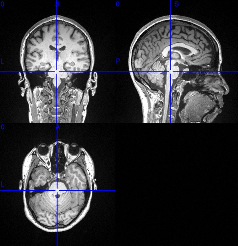 拡張する脳：頭の中をスキャン うつ病を「脳状態の異常」と捉える試み