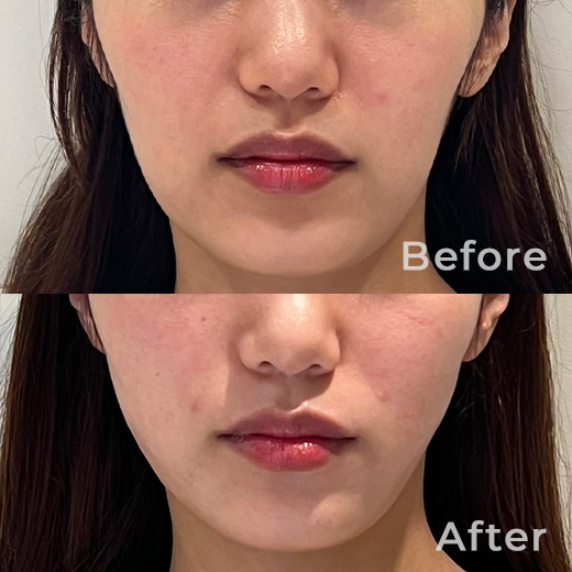 東京・銀座でスレッドリフトなら｜クリスティーナクリニック