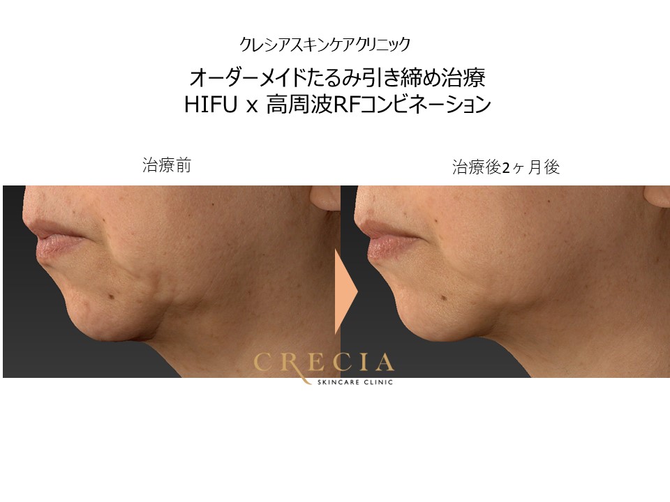 HIFUハイフ】x【RF高周波オリジオ】のコンビネーションたるみ引き締め