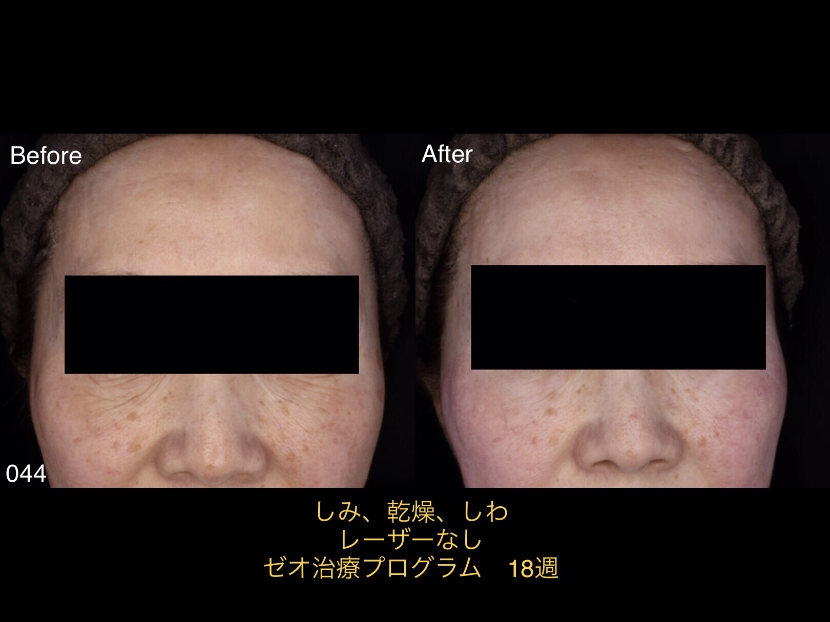 ゼオスキンの思わぬ効果！シミだけではないゼオスキンの底力！症例写真