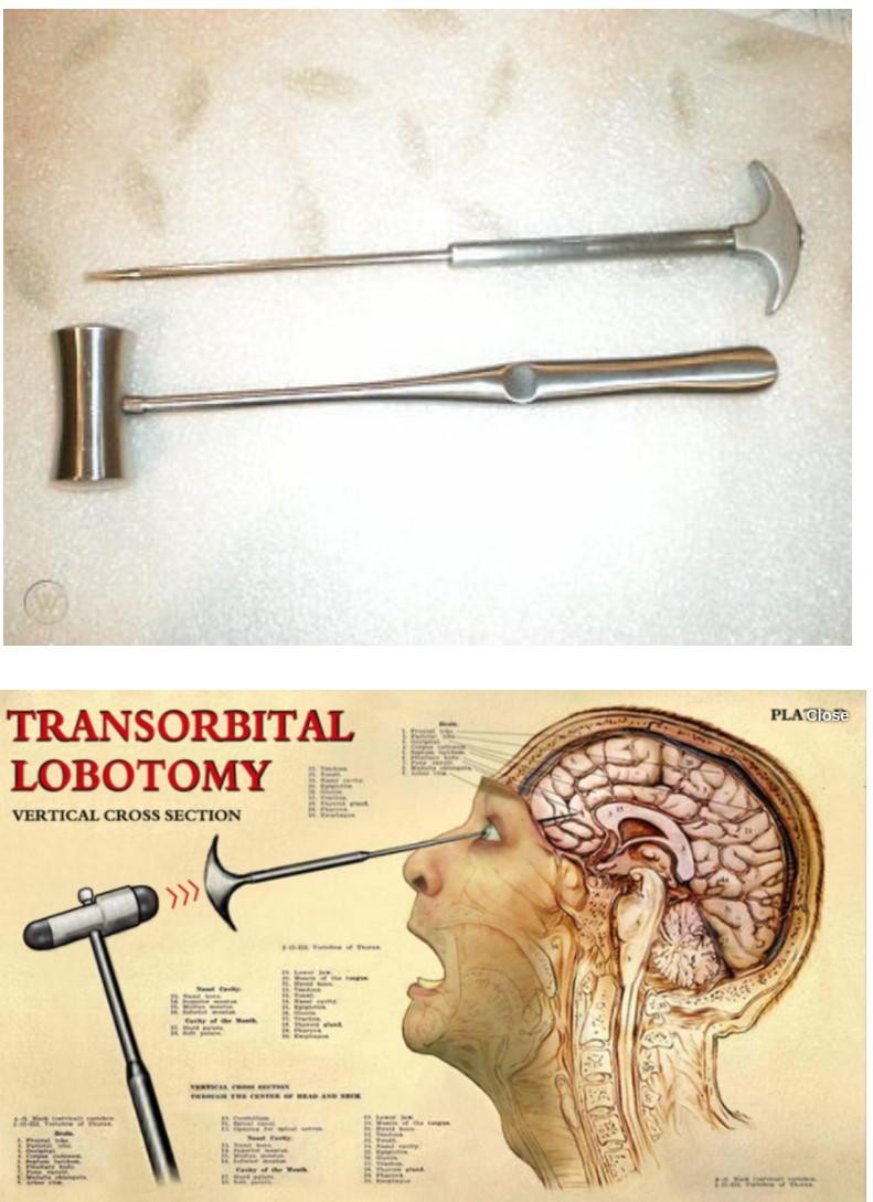 Orbitoclast – lobotomy tools : r/interestingasfuck