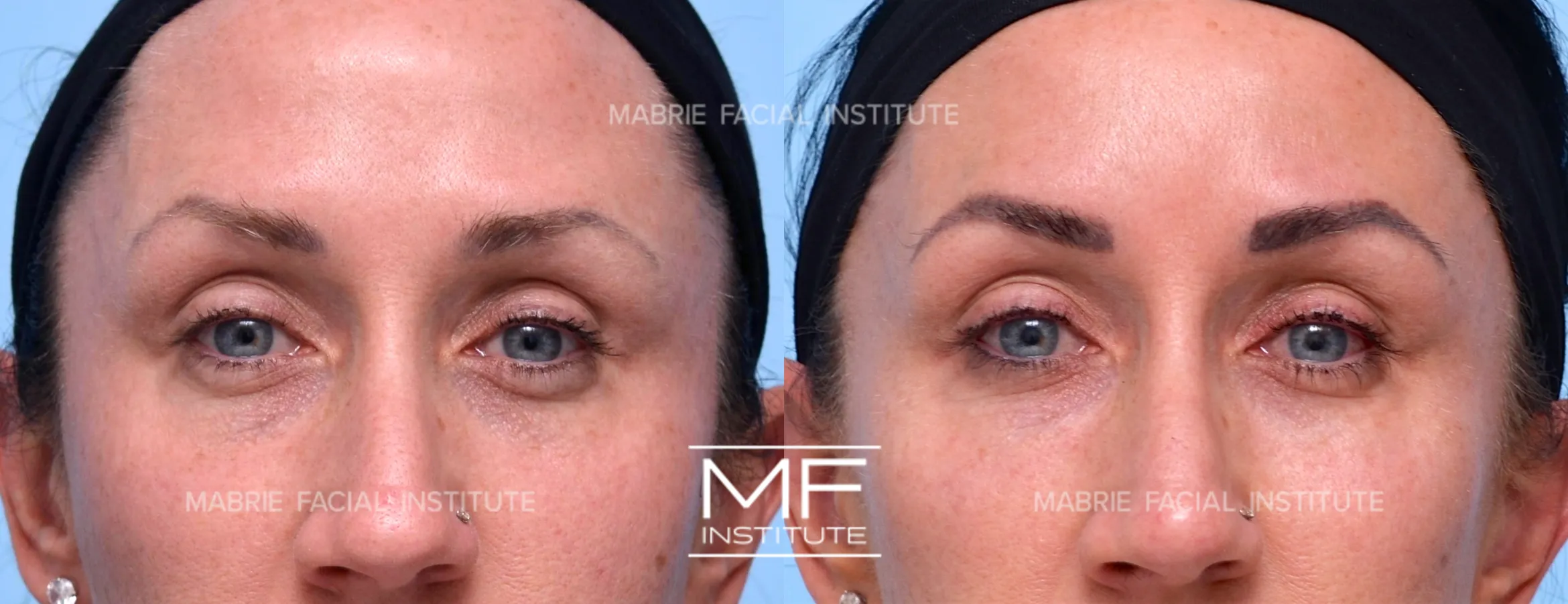 under-eye-bulging-920-view-1-