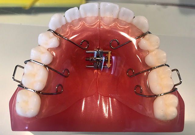 非抜歯矯正でよく使う装置｜矯正・自由が丘歯科室