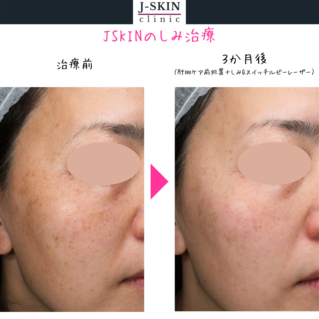 症例シリーズ8｜しみ】しみだけでなく肝斑にもそれぞれのケアが重要