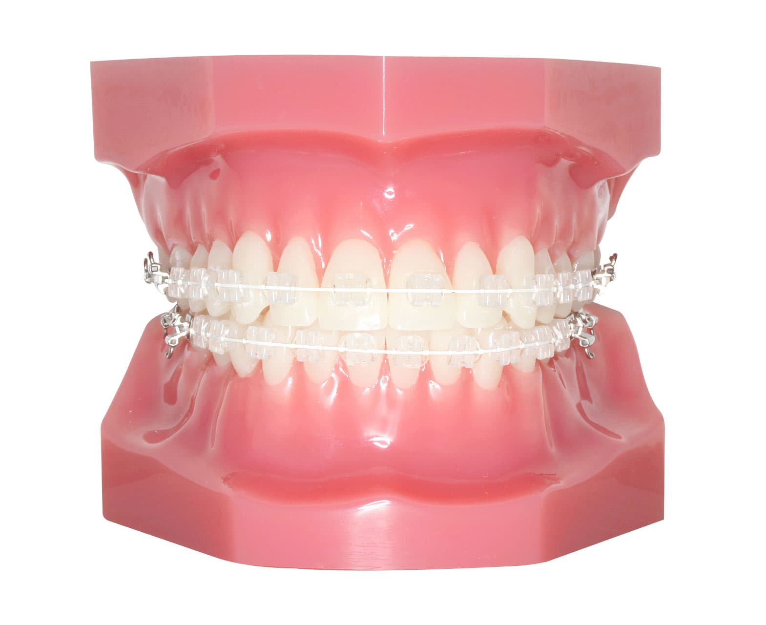 矯正装置の種類 | 葛西モア矯正歯科｜葛西駅から徒歩0分・西葛西駅も