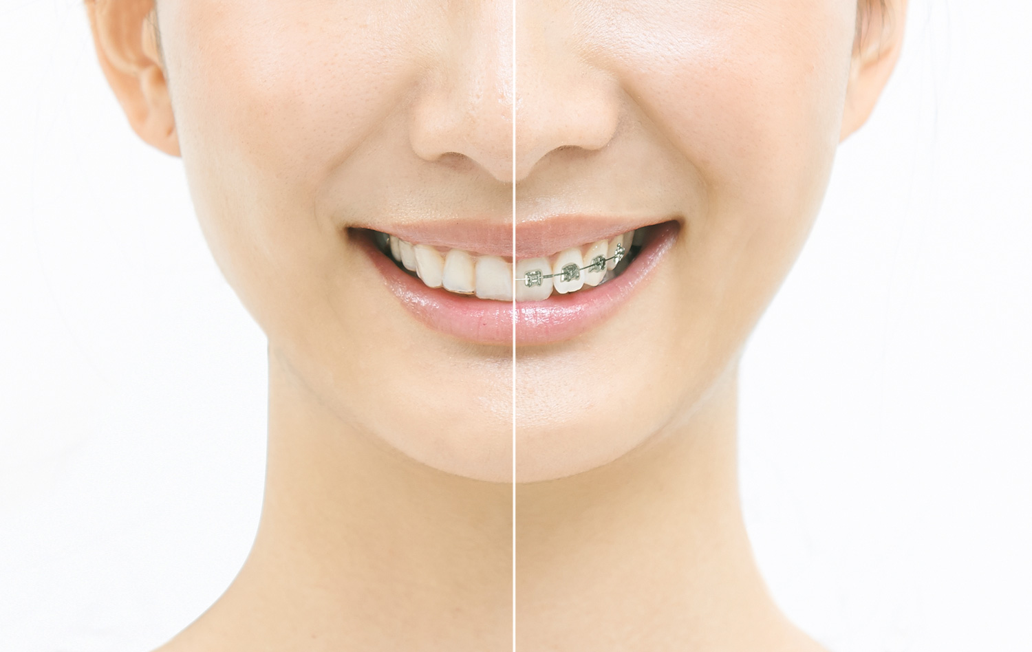 マウスピース型矯正装置（インビザライン・SureSmileアライナー