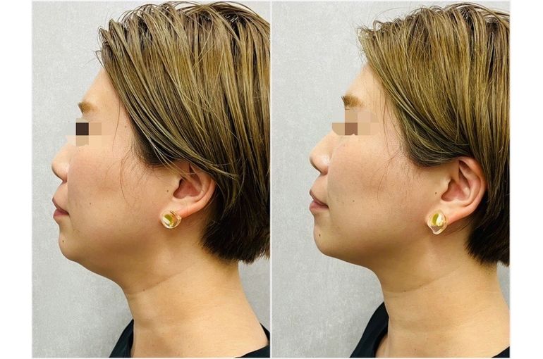 リアボーテ 大阪】新商品 脂肪妖怪 ディゾセラム