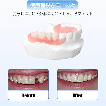 Amazon.co.jp: Dentellea カスタム 入れ歯 部分 取り外し可能 義歯
