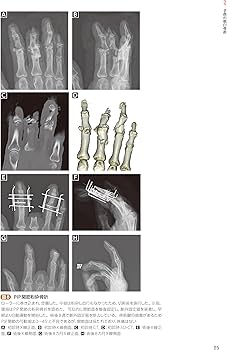 手外科手術ノート part2：代表的な骨折・外傷編 | 大井宏之 |本 | 通販