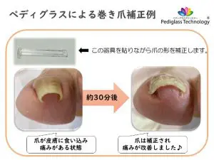 知っておきたい巻き爪ケア・対策――ペディグラスによる補正や足の環境