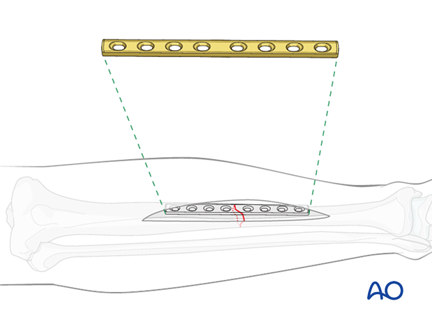 ORIF - Compression plating for Simple fracture, transverse