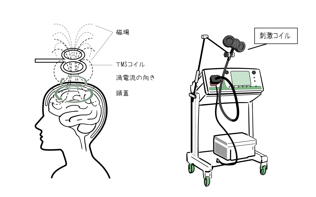 TMS治療の実際｜福岡市早良区西新の心療内科・精神科｜ひとやすみ