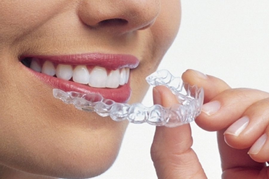 マウスピース矯正（インビザライン） - 御茶園通り歯科クリニック