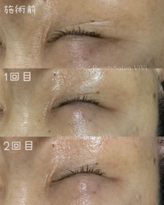 肌人生が変わる♡ラミネーションピール - フェイシャルエステ・毛穴