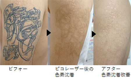 タトゥークリーム｜ドクターズコスメ・サプリ通販｜ルーチェクリニック