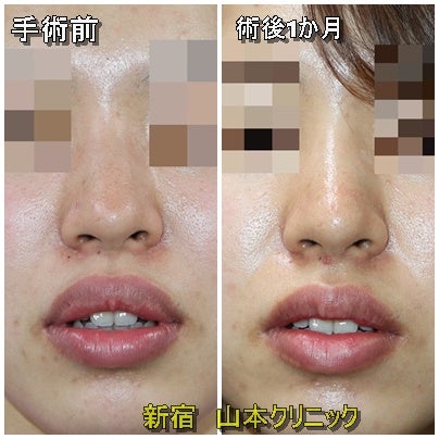 たらこ唇を治す？ | やまくり女子すたっふの美的日常