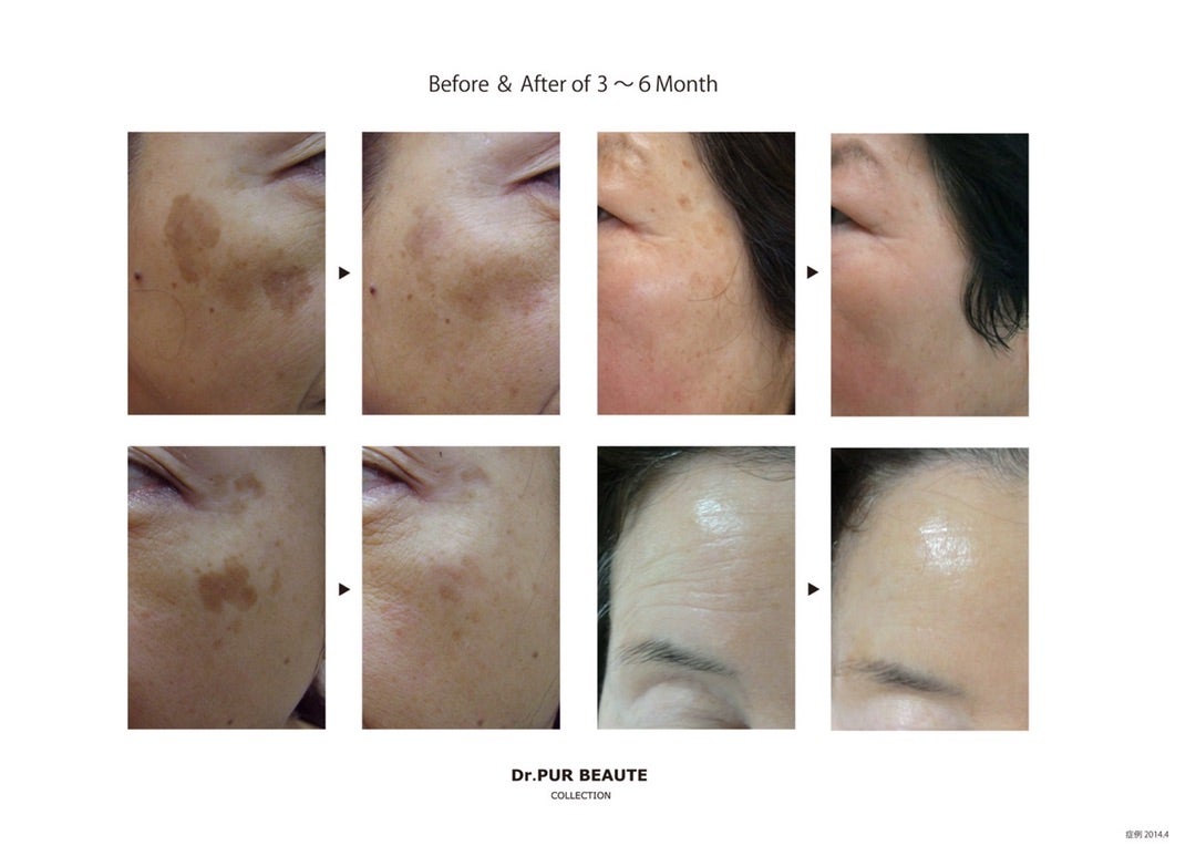Dr.PURピュールボーテ【#6美白クリーム】美容皮膚科クリニック提携