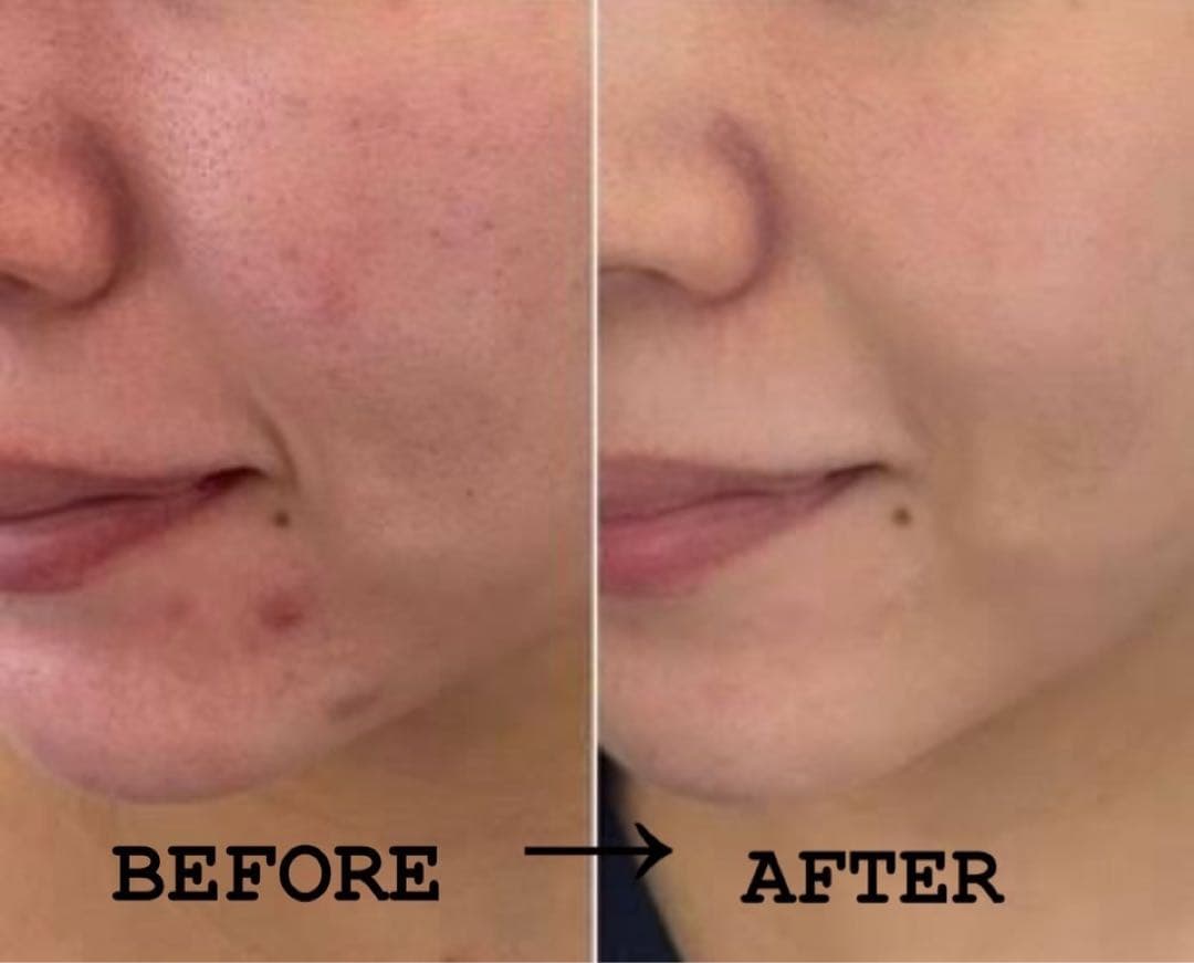 ハーブピーリング　剥離あり　7回分→７ｇ