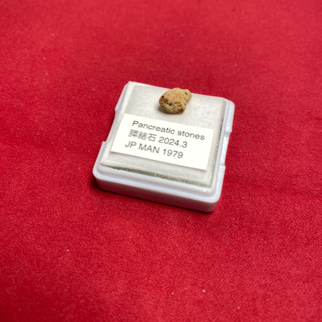 【超希少石】膵結石　超希少な膵結石　膵石　スイセキ　人体石標本資料
