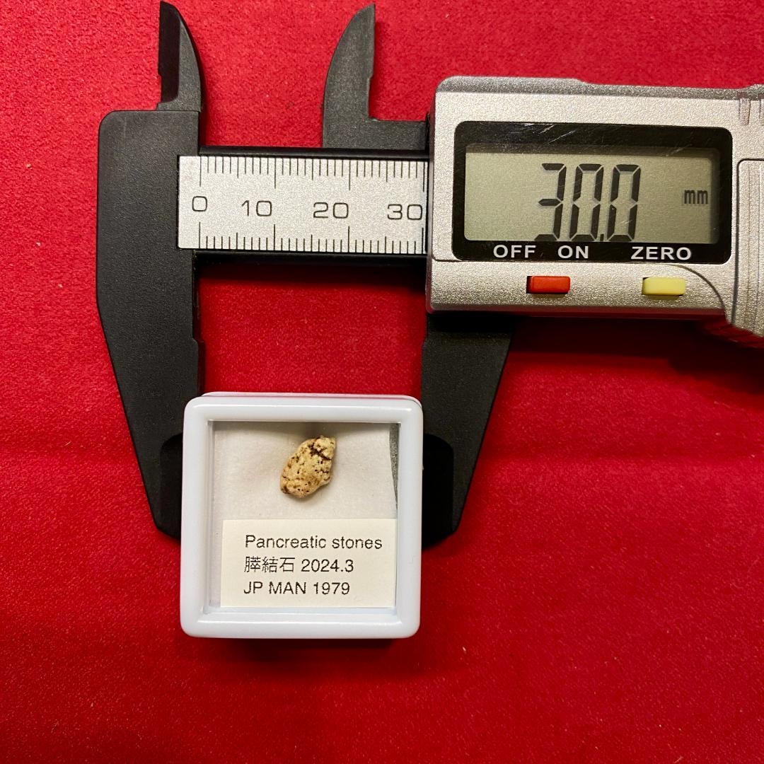 【超希少石】膵結石　超希少な膵結石　膵石　スイセキ　人体石標本資料